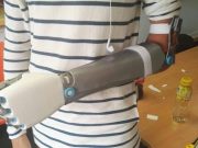 Abierta convocatoria para entregar prótesis a personas con afectación en antebrazos